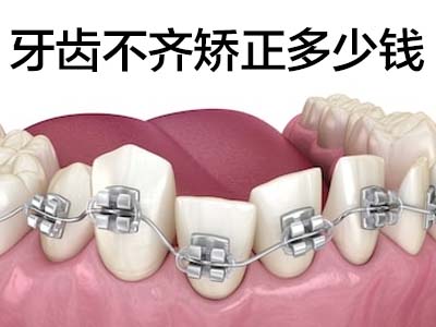 天津牙齿畸形矫正牙齿大概需要多少钱