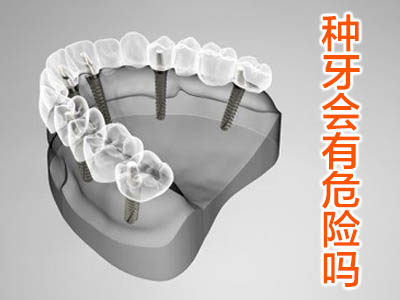 了解详细全口种植牙的过程 天津中诺医院刘子豪
