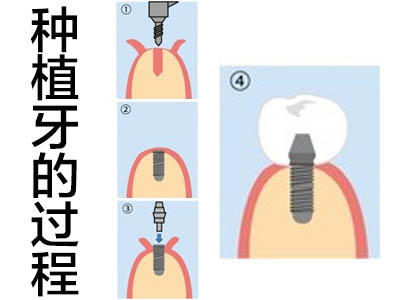 种植牙价格 天津种两颗门牙需要多少钱?