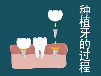 安装牙冠过程图解种牙  天津allon4种植牙详细步骤?