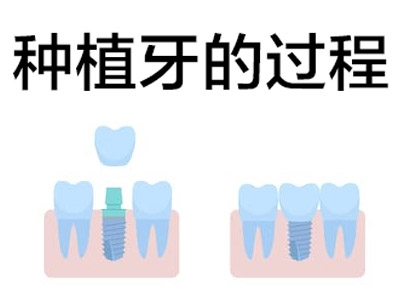 天津上颌骨种植牙二期修复的时间