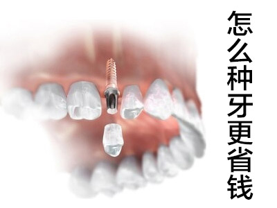 了解种植牙多少钱一颗2022价格表天津