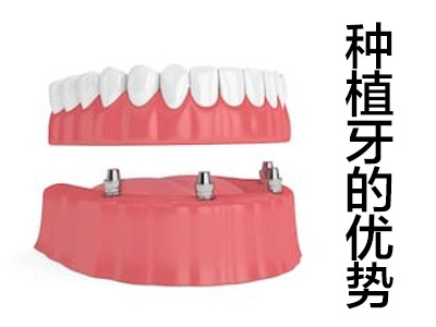 天津北辰种一颗牙需要多少钱