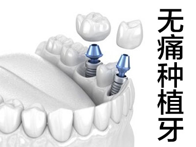 天津南开国产种植牙多少钱一颗2021价格表