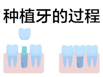 天津东丽种植牙齿多少钱一个2022