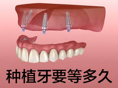 解答天津南开国产普通半口牙需要多少钱