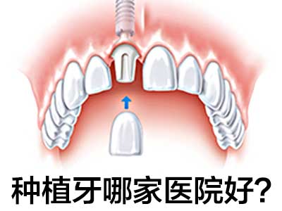 种植牙医院排名  天津市宁河区哪家医院牙科好?