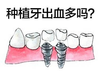 天津东丽一颗种植牙的费用是多少