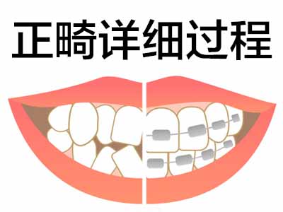 科普天津11岁牙齿隐形矫正过程讲解视频