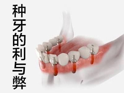 了解天津补好的牙齿能维持几年 种植牙寿命