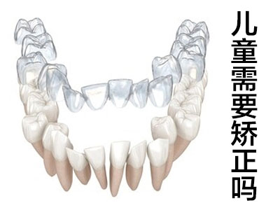 天津13岁地包天牙齿矫正的价格表 牙齿矫正多少钱