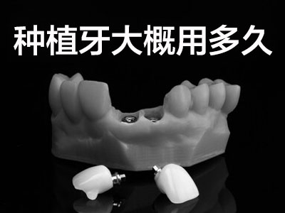 奥齿泰使用寿命  天津韩国奥齿泰种植牙能用多久