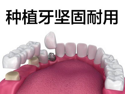 天津韩国登腾全瓷牙冠种植牙价格表