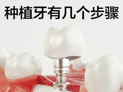 种植牙全过程视频  天津65岁老年人种植牙的步骤