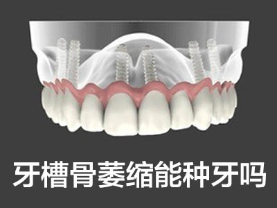 天津人工种植牙价钱大概多少 价格表已出