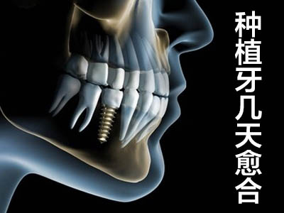 种植牙价格 天津牙齿的全口种植牙价钱