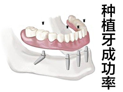 种植牙价格 天津全口种植牙加植骨要多少钱
