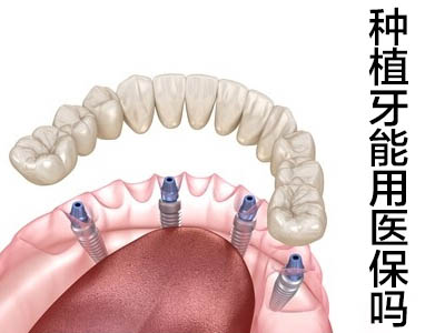 认知天津韩国亲水种植牙多少钱一颗