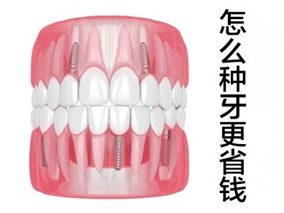 解答天津人工种植一颗牙需要多少钱