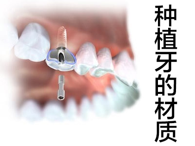 天津韩国纯钛种植牙要多少钱一颗