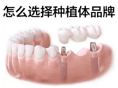 天津做种植牙半口需要多少钱