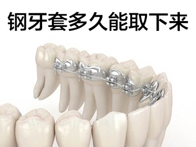 钢丝牙套价目表  天津钢丝牙套矫正牙齿大概要多少钱