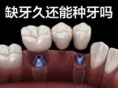 天津韩国种植牙基台多少钱一颗 全新价格表