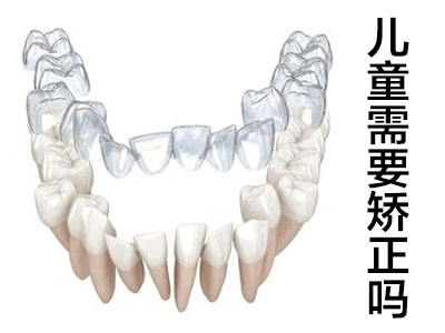 科普天津30岁牙齿缝隙大矫正价格多少钱