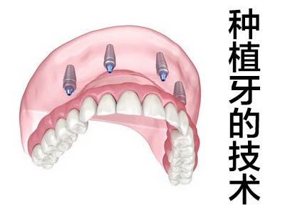 天津拔牙后多长时间可以做种植牙修复