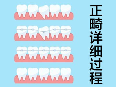 牙齿矫正多少钱 天津成人牙齿矫正钢牙套价格