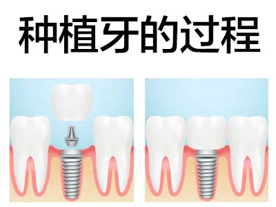 天津全口牙种植一般戴多长时间
