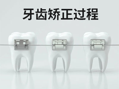 矫正牙齿过程要多久时间 天津成人矫正牙齿需要多久