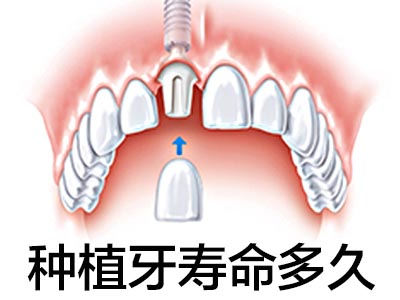 天津半口半固定种植牙能用多久