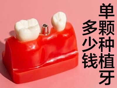 解答天津安一口种植牙大概需要多少钱