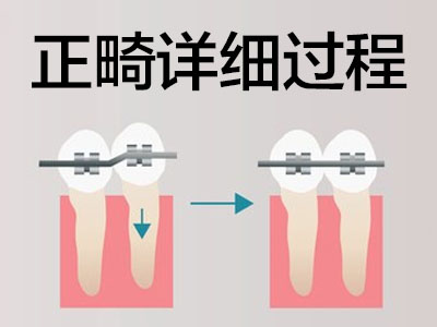 天津成人矫正牙齿需要注意什么