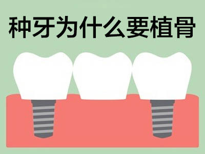 解答天津allon4全口种植牙价格 种植牙多少钱