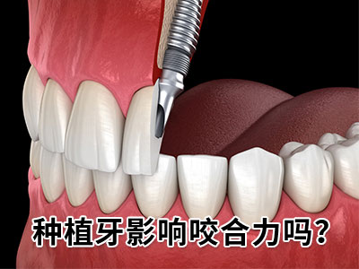 牙齿即拔即种过程  天津即拔即种植牙需要多长时间