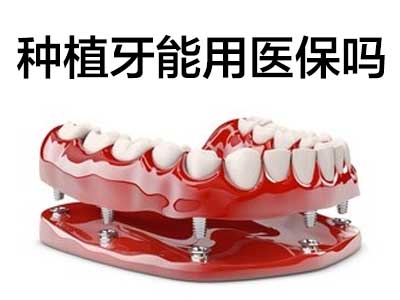 天津进口种植牙需要多少钱