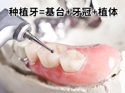 天津北辰区医院牙种植价格-天津种植牙齿多少钱一个