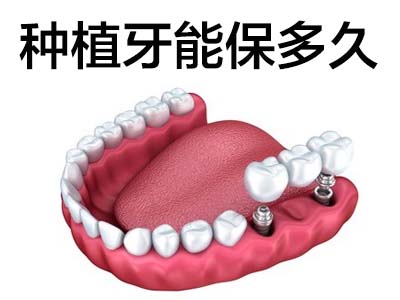 天津老人全口种植牙需要几颗