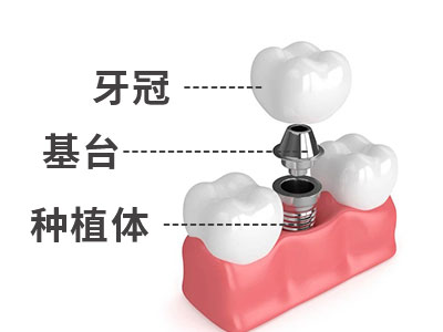天津现在的种植牙要多少钱-种植一颗牙齿价目表