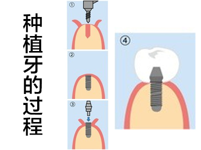 天津门牙种植牙二期手术视频