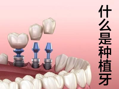 天津牙齿的全口种植牙价格