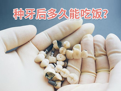 详细的天津国产种植牙一颗多少钱明细