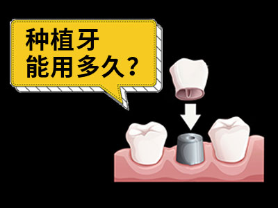 天津30岁种植牙可以用多久-天津种牙一般能保持多久