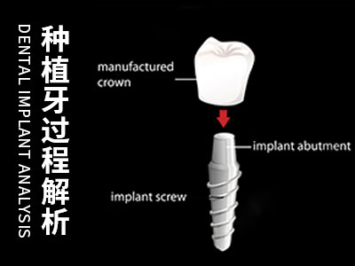 天津半口半固定种植牙二期手术-天津上半口种植牙图片大全