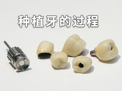 具体的天津补一颗种植牙大概多少钱