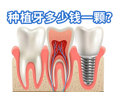 天津25岁满口种植牙一般要多少钱-天津满口全牙多少需要多少钱