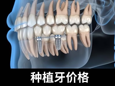 天津成人种植牙多少钱一颗图片