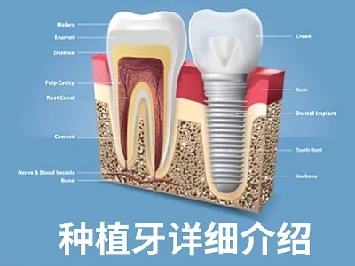 天津现在种植牙的品牌及价格是多少钱